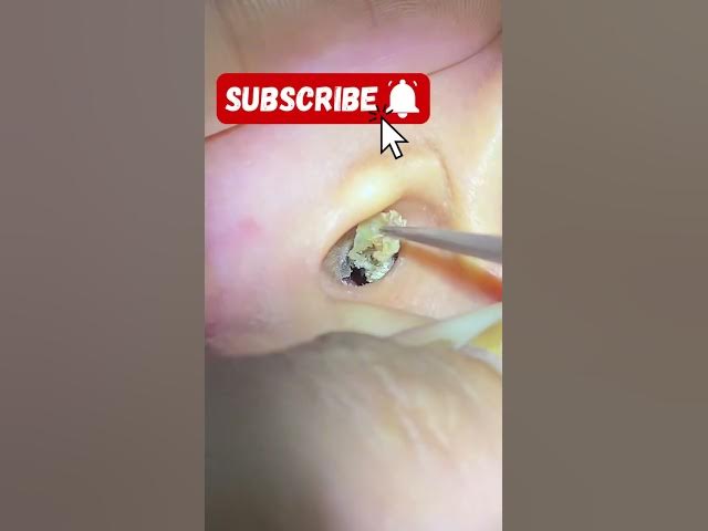 Video thumbnail for Earwax Removal for an Inflamed Eardrum – Gentle and Safe Procedure | Deep Ear Cleaning ASMR