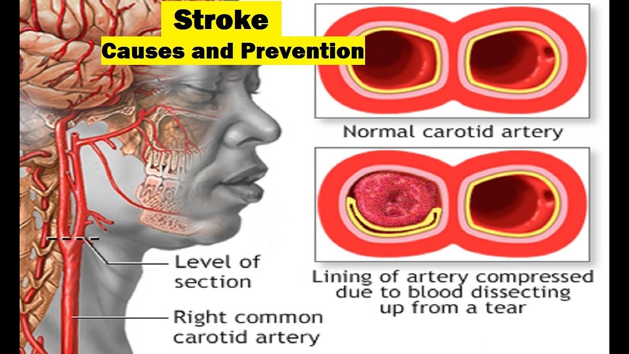 Video thumbnail for Stroke : Causes and prevention