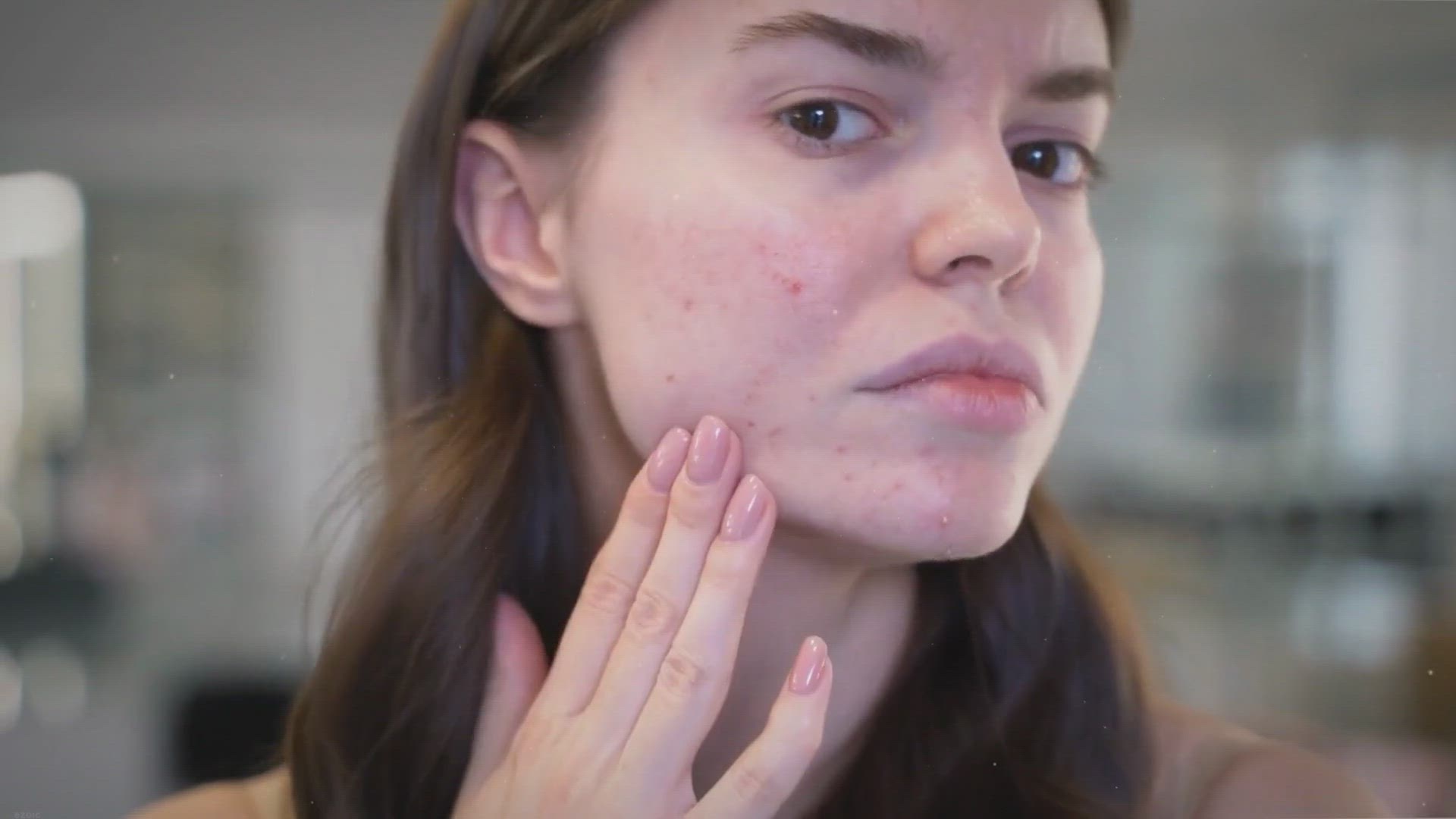 Video thumbnail for Blackheads: Unmasking the Causes, Debunking Myths, and Mastering Removal and Prevention