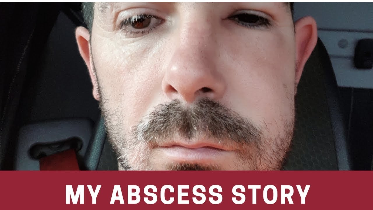 Video thumbnail for Abscess | cyst | abscess tooth