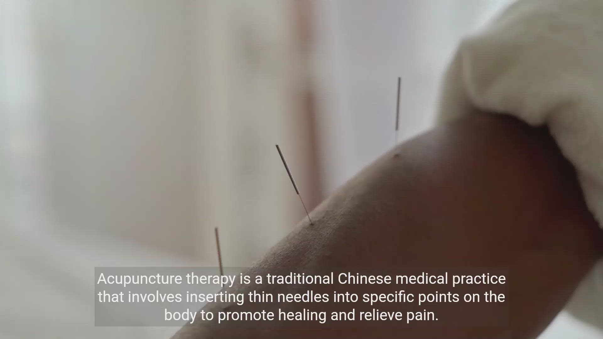 'Video thumbnail for Acupuncture Therapy: Benefits and Techniques'