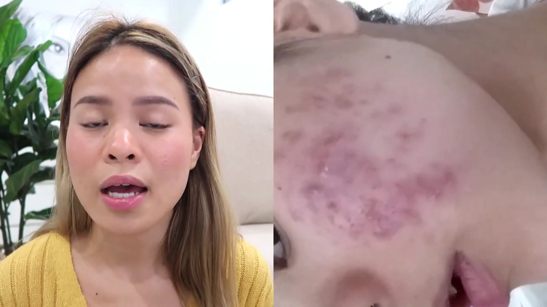 Video thumbnail for Microneedling Mistakes Slowing your Results Part II (720p 25fps)