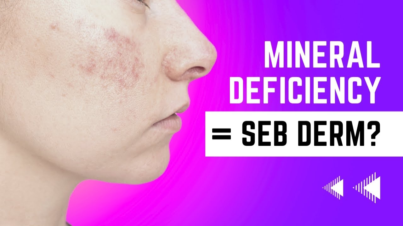 Video thumbnail for These Mineral Deficiencies Worsen Seborrheic Dermatitis