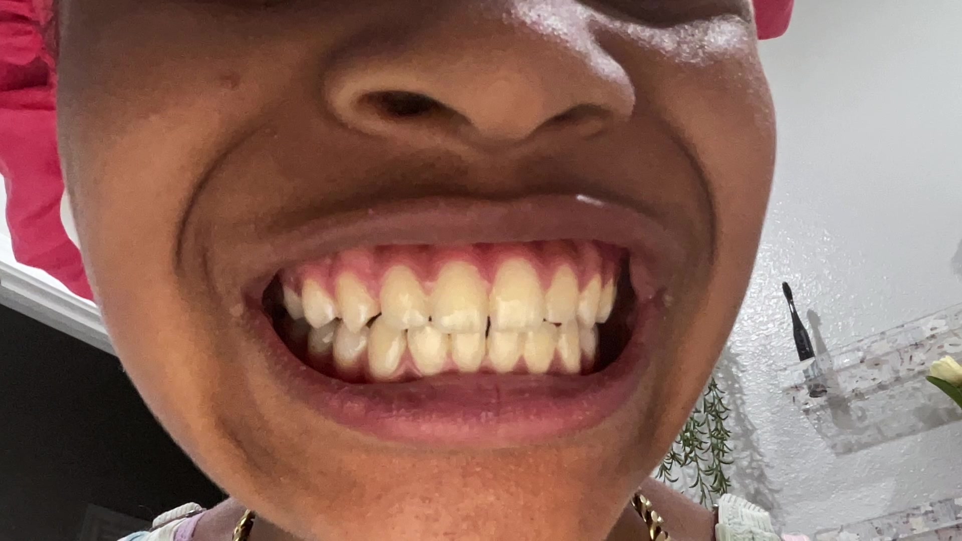 Video thumbnail for White teeth hack works?