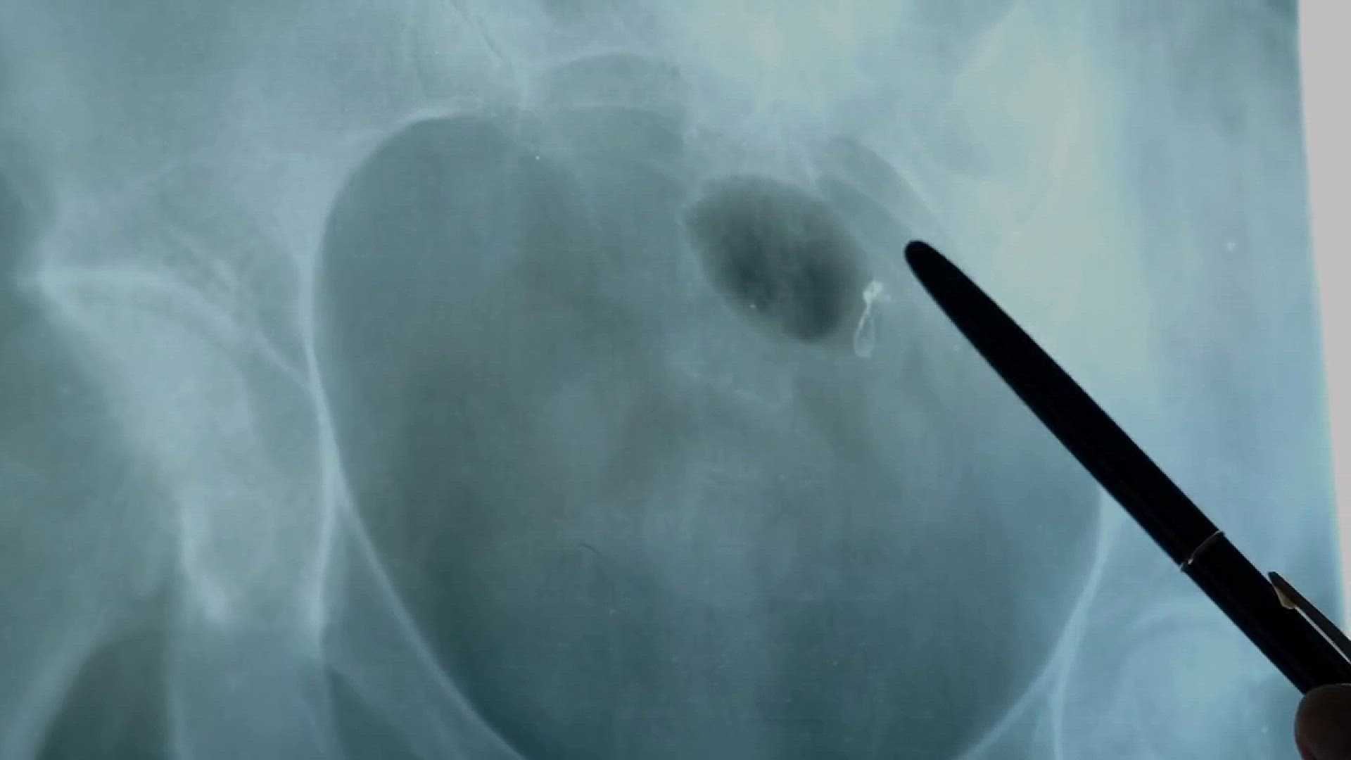 Video thumbnail for 10 Warning Signs You May Have Kidney Stones – Don’t Ignore These!