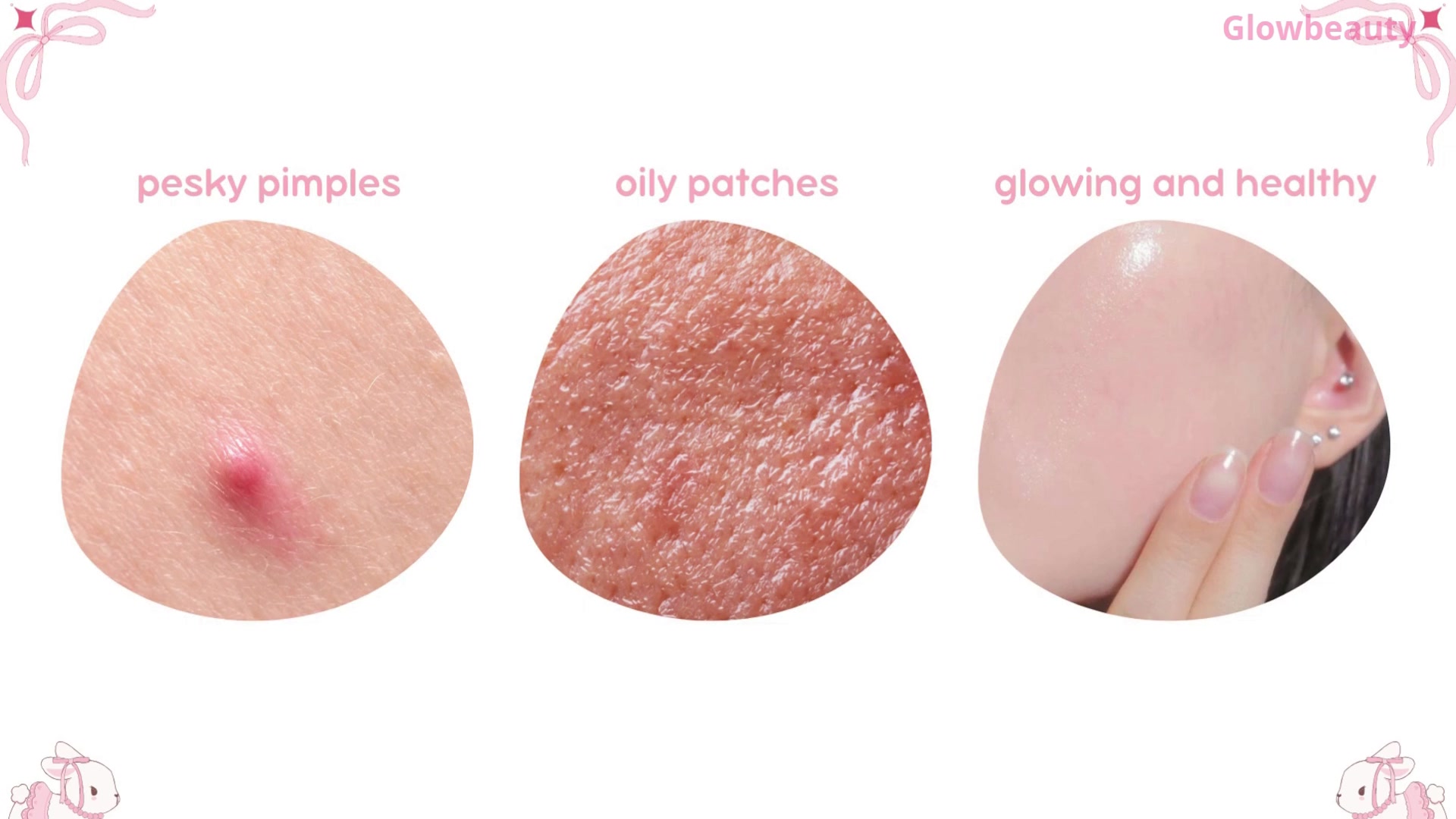 Video thumbnail for how to get rid of pimples | skincare |skincare routine | acne prone skin