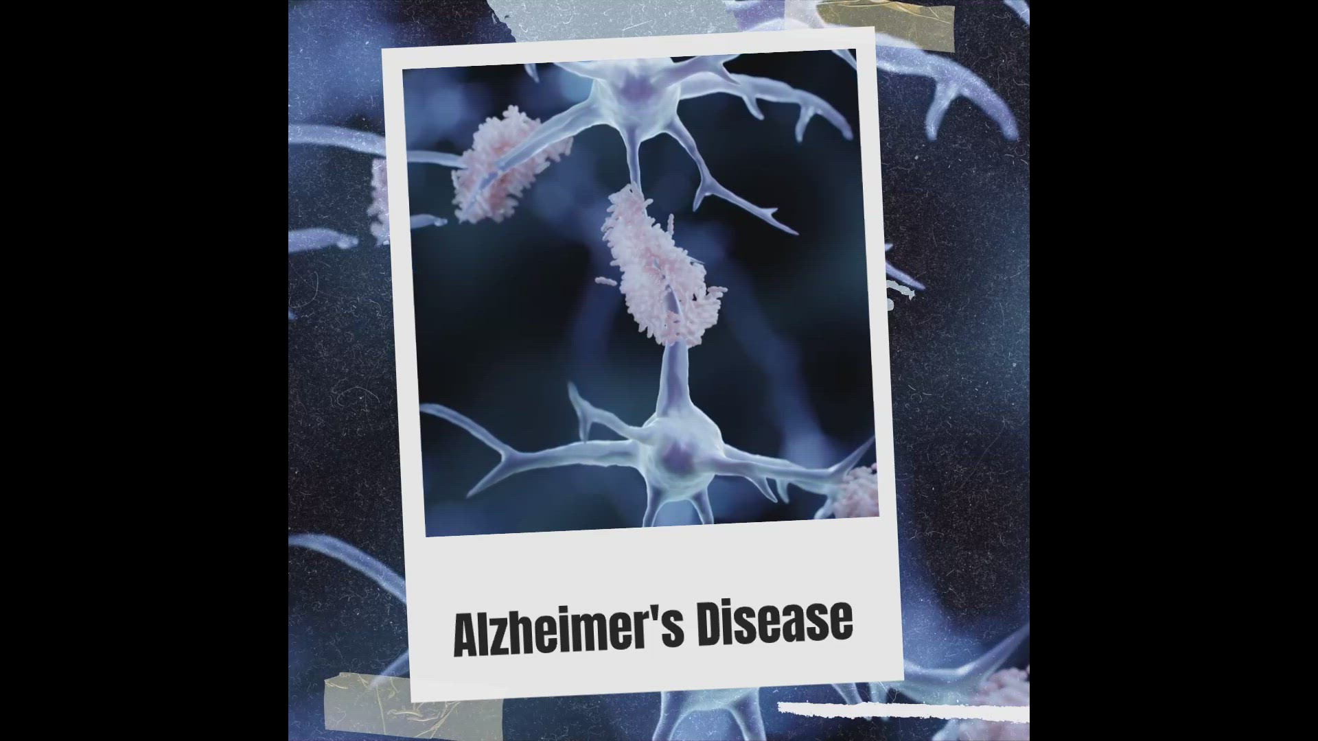 'Video thumbnail for Understanding Alzheimer's Disease'