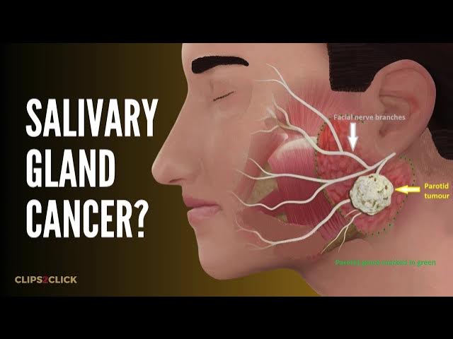 'Video thumbnail for Salivary Gland Cancer: Symptoms, Causes, & Treatment Options'