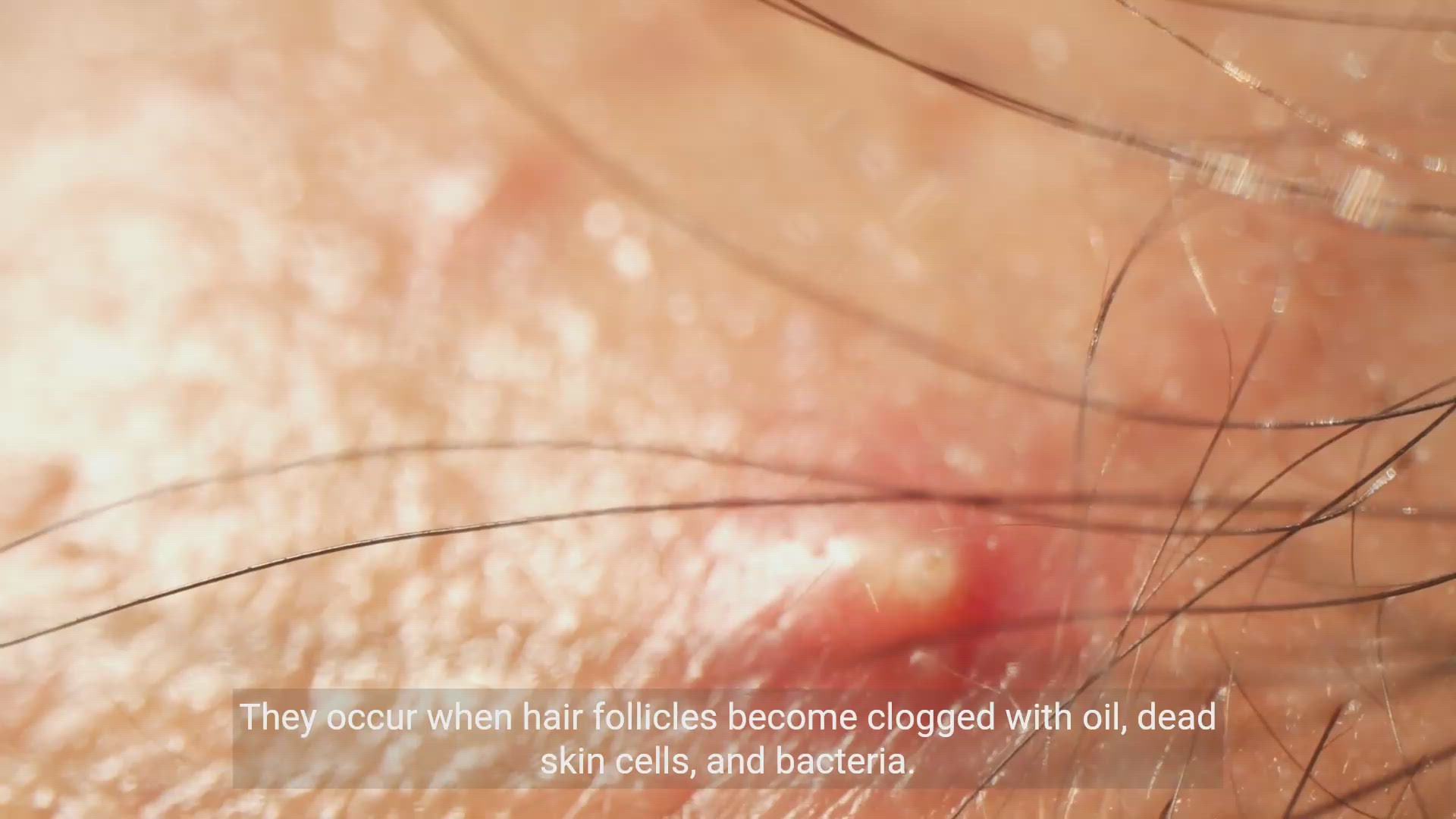 'Video thumbnail for Dealing with Pimples: Effective Tips and Remedies '