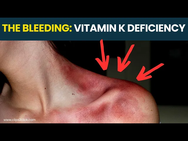 'Video thumbnail for Vitamin K Deficiency Symptoms: Scary Signs You're Bleeding Too Much'