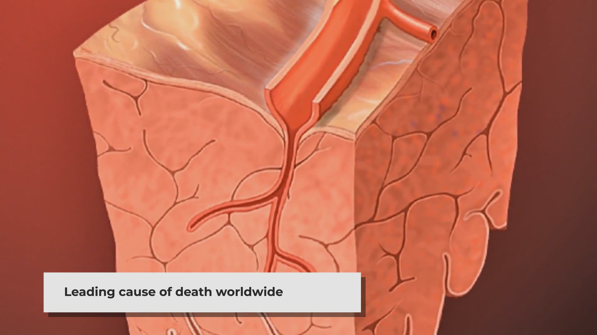 'Video thumbnail for Coronary Artery Disease: Understanding Risks and Prevention'