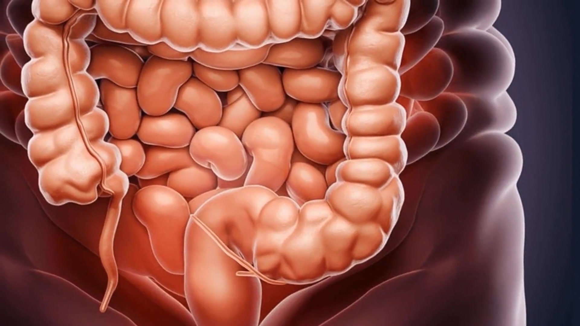 video of: Poop and Colon Cancer: Early Warning Signs, When to Seek Help