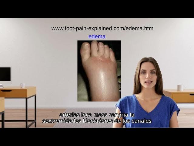 Video thumbnail for edema