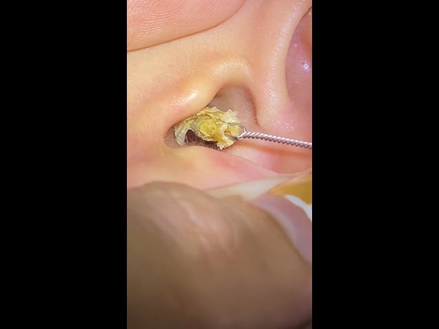 Video thumbnail for You Won’t Believe What Came Out of This Ear! | Deep Ear Cleaning ASMR