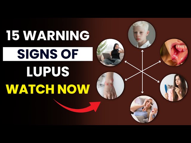 Video thumbnail for 15 Warning Signs of Lupus You Should NEVER Ignore | Early Symptoms of Lupus | Fitwise Daily
