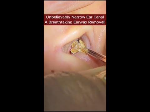 Video thumbnail for Unbelievably Narrow Ear Canal – A Breathtaking Earwax Removal! | Deep Ear Cleaning ASMR