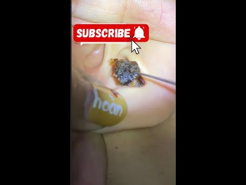 Video thumbnail for Clay-Like Earwax Removal – Hard as Stone, Took Forever to Get Out! | Deep Ear Cleaning ASMR