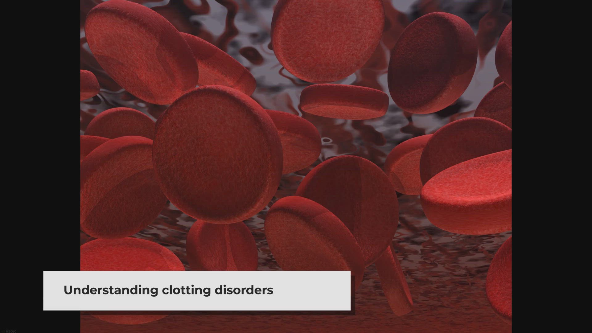 'Video thumbnail for Understanding Clotting Disorders: A Comprehensive Guide (ICD-10)'